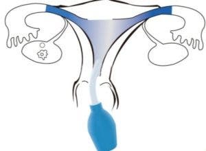 Duchas vaginales